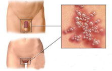 生殖器疱疹一般有哪些症状