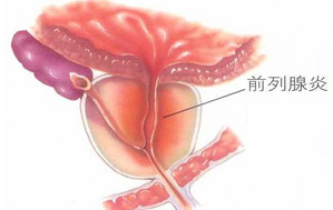 前列腺炎有什么症状