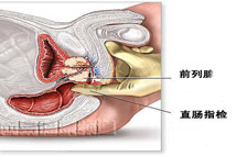 前列腺增生有哪些原因