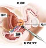 前列腺癌的死亡率高吗？