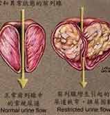 前列腺增生怎样治疗效果好